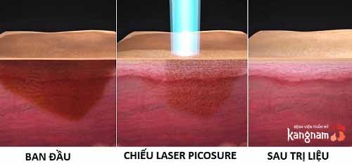 Laser Picosure trị tàn nhang