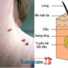 Giải thích nguyên nhân và chia sẻ 3 cách trị mụn thịt dư ở quanh cổ hiện nay