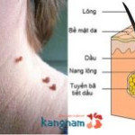 Giải thích nguyên nhân và chia sẻ 3 cách trị mụn thịt dư ở quanh cổ hiện nay