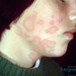 Mặt nổi mẩn đỏ không ngứa là bệnh gì? Những lưu ý để nhanh khỏi