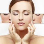 5 Cách trị tàn nhang trên mặt, làm trắng da hiệu quả chỉ sau 7 ngày!