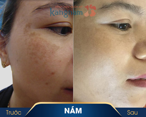 điều trị nám bằng laser