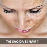 Tổng hợp những nguyên nhân gây nám da mặt có thể bạn chưa biết