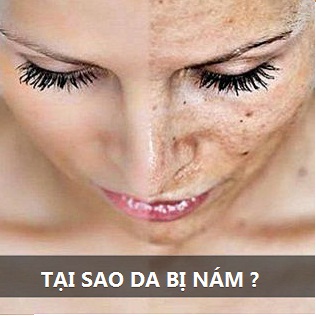 Tổng hợp những nguyên nhân gây nám da mặt có thể bạn chưa biết