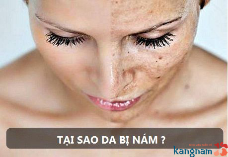 nguyên nhân gây nám da