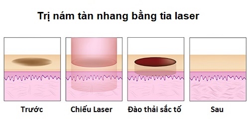 trị nám bằng laser