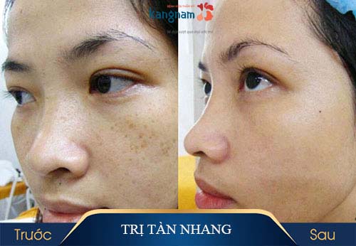 trị tàn nhang bằng laser