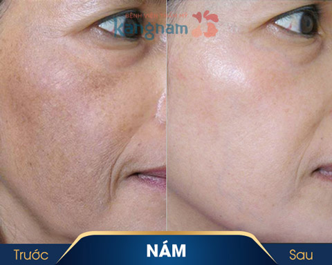 khách hàng trị nám 2