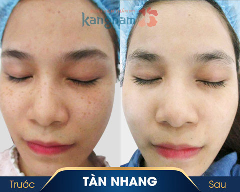 khách hàng trị tàn nhang 1