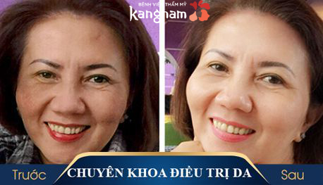 trị nám mảng 