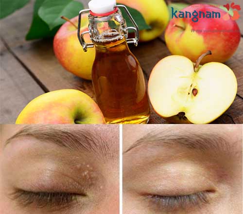 Cách loại bỏ mụn thịt bằng dấm táo được nhiều người sử dụng làm sao để hết mụn thịt