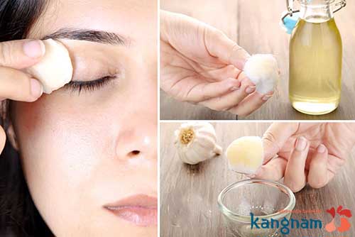 Tỏi chữa mụn thịt hiệu quả mụn thịt ở mí mắt