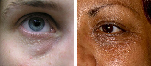 Mụn thịt có nguy hiểm không? mụn thịt quanh mắt