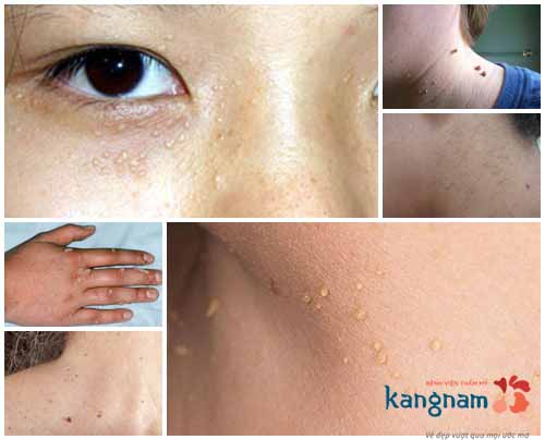 Mụn thịt mọc ở nhiều vị trí khác nhau, tập trung nhiều nhất ở quanh mắt các loại mụn thịt