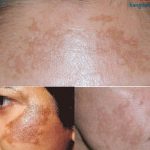 Nám mảng là gì? Dấu hiệu nhận biết và cách điều trị hiệu quả