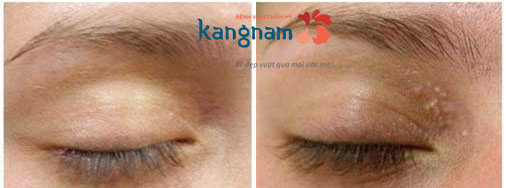 Mụn thịt như thế nào? mụn đá