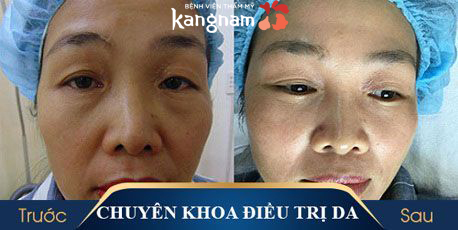 trị mụn thịt bằng laser co2