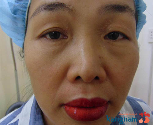 Mụn thịt quanh mắt lan ra rất nhanh nếu không có cách chữa trị kịp thời trị mụn thịt quanh mắt