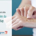 Chia sẻ cách trị nám da tay hiệu quả của bà mẹ U40