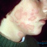 Mặt nổi mẩn đỏ không ngứa là bệnh gì? Những lưu ý để nhanh khỏi