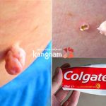 Kinh nghiệm trị mụn thịt bằng kem đánh răng của bà mẹ 3 con!