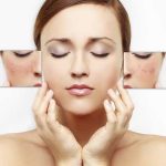 5 Cách trị tàn nhang trên mặt, làm trắng da hiệu quả chỉ sau 7 ngày!