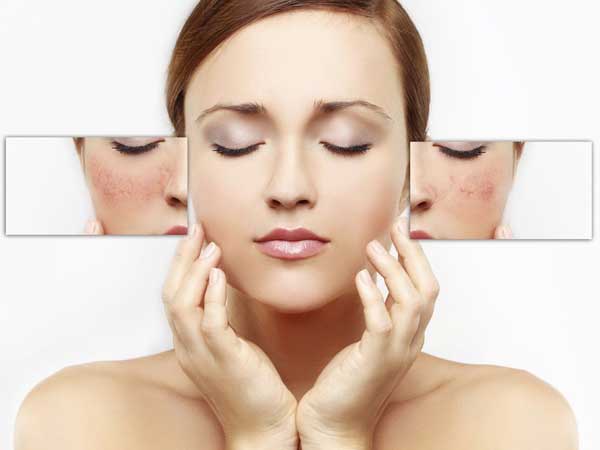 5 Cách trị tàn nhang trên mặt, làm trắng da hiệu quả chỉ sau 7 ngày!