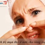 Hướng dẫn cách trị mụn thịt ở mũi cho từng loại da khác nhau