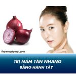 Mách bạn cách trị nám bằng hành tây và những lưu ý cần biết khi sử dụng!