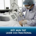 Bắn, Đốt mụn thịt bao lâu thì lành? Có để lại SẸO không? Cần lưu ý gì?