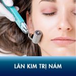 Tất tần tật những điều bạn cần biết về phương pháp lăn kim trị nám