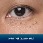 Mụn thịt là gì? Nguyên nhân và cách điều trị mụn thịt ở mắt hiệu quả nhất