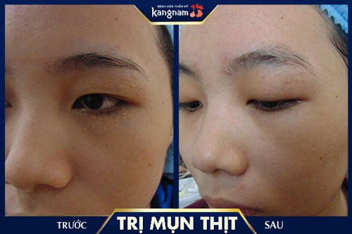 trị mụn thịt quanh mắt