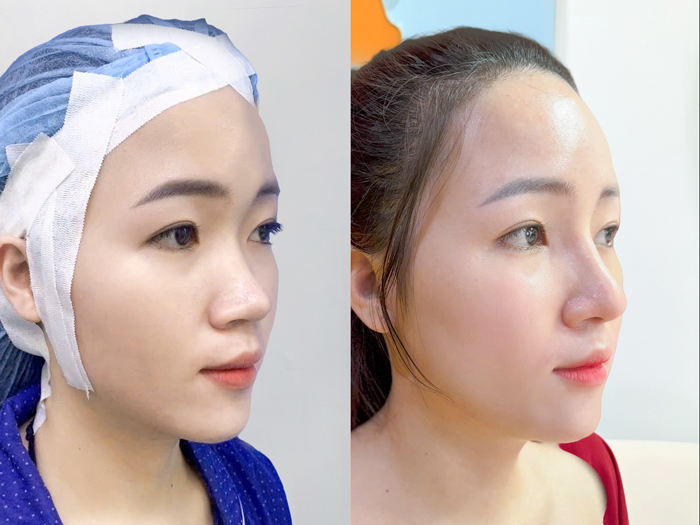 khách hàng hài lòng với nâng mũi sau phẫu thuật