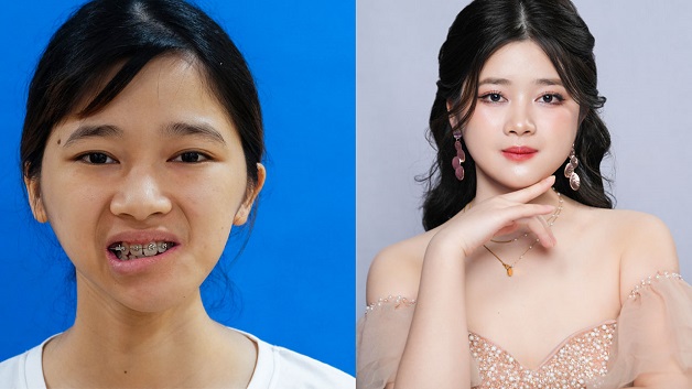 Cô bé mặt lõm Ninh Thu Hường hóa thành công chúa sau phẫu thuật