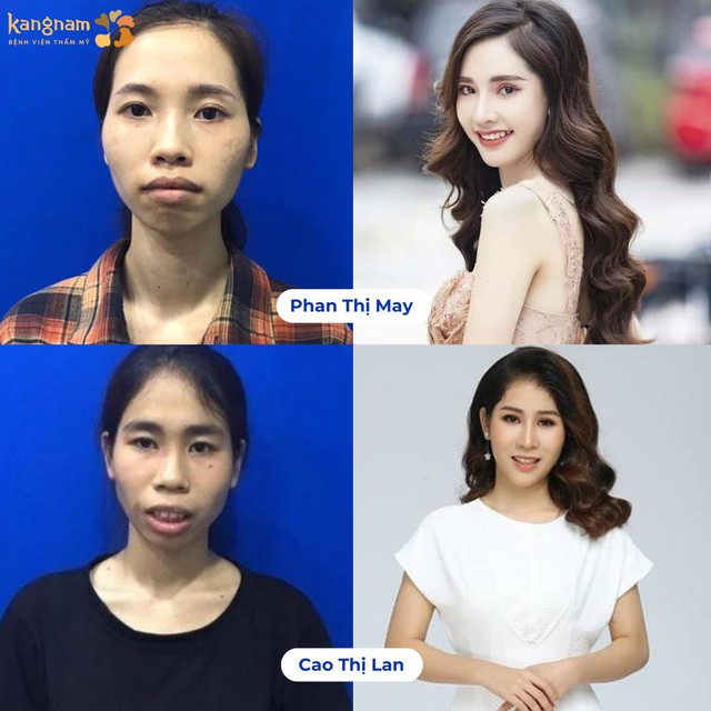 2 cô nàng lột xác nhờ phẫu thuật thẩm mỹ đã từng gây xôn xao khắp cõi mạng